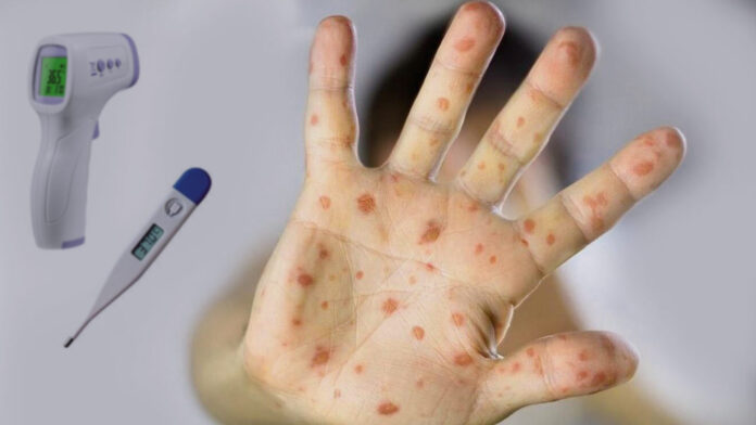 covid 19 vaccines don’t cause monkeypox